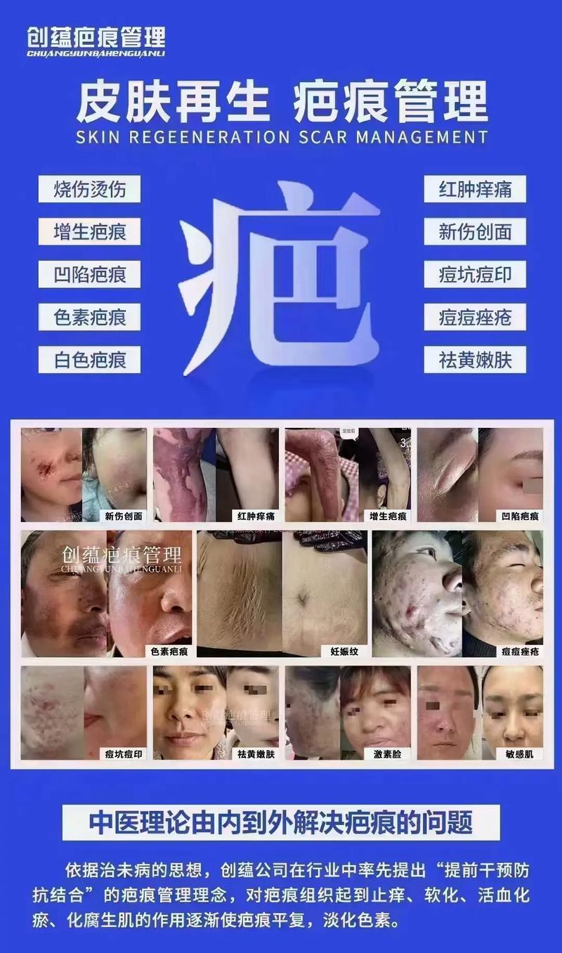 斑疤敏痘紋痘坑全解析 創(chuàng)蘊除疤精準修護，重塑無瑕美肌